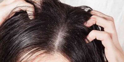 home remedies to cure dandruff