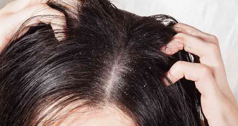 home remedies to cure dandruff