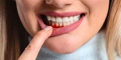 treat inflamed gums naturally