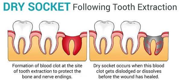 how to treat dry socket