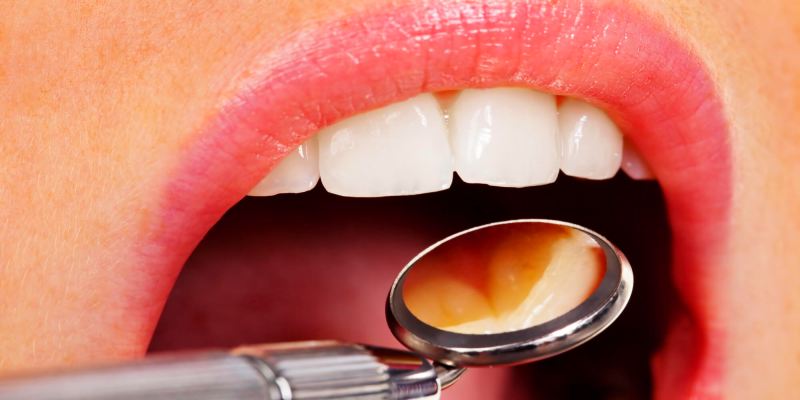 how to treat dry socket