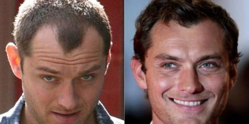 hair transplant jude law