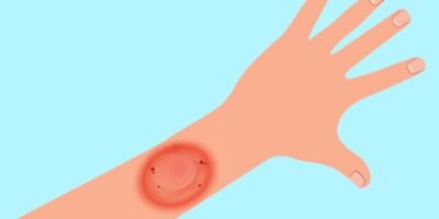 how to treat a ringworm